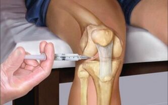 intra-articular injection into the joint for arthropathy