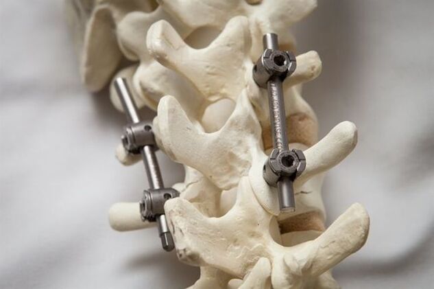 fixation of the osteochondrosis of the cervical spine