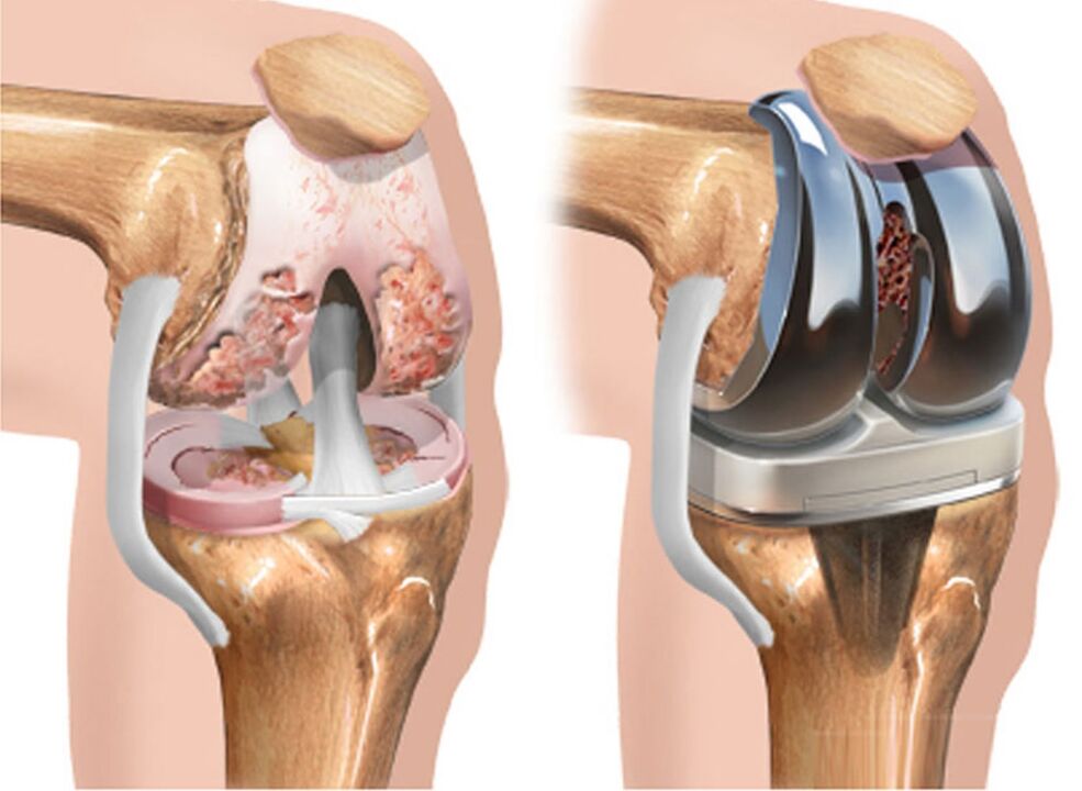 before and after arthritis of the knee joint for arthritis