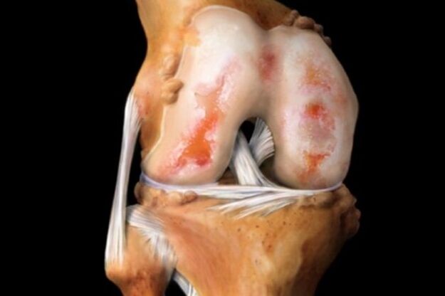 cartilage damage in knee arthritis
