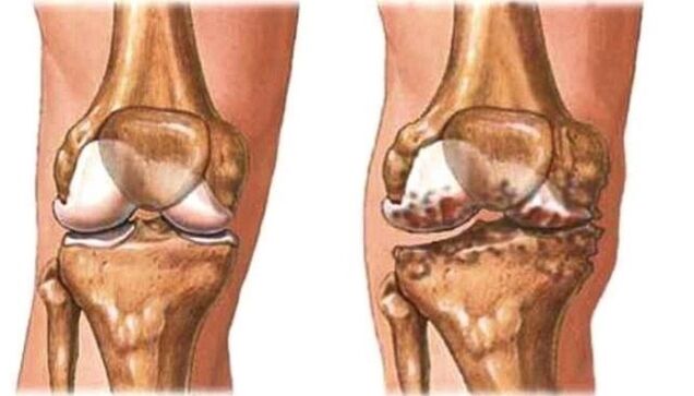 healthy knee and knee arthritis
