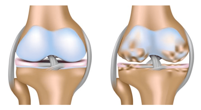 healthy cartilage and damage to the knee joint with joints