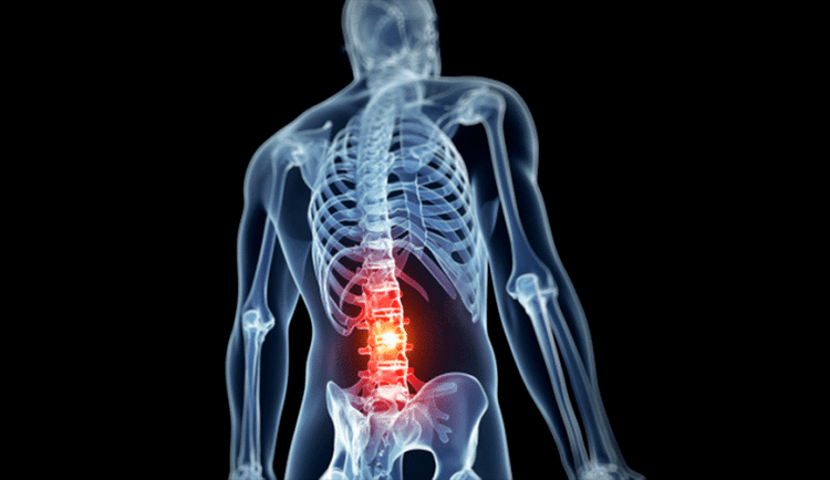 damage to the lumbar spine in osteochondrosis