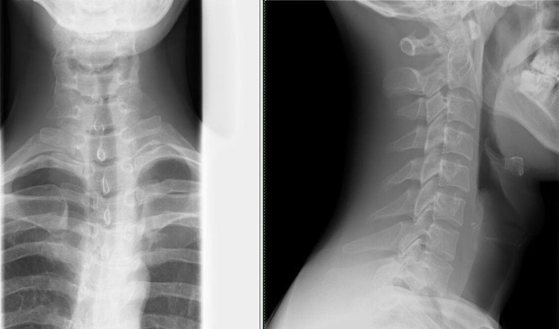 X-ray of the spine is a simple and effective method for diagnosing osteochondrosis