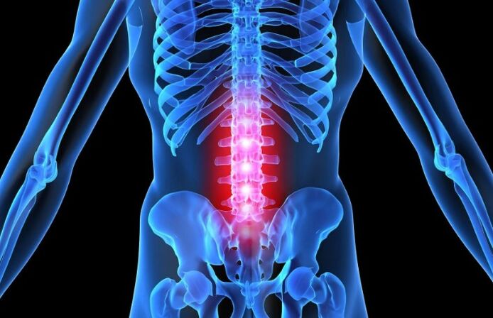 Osteochondria of lumbar region