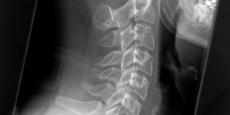 A picture of the cervical area