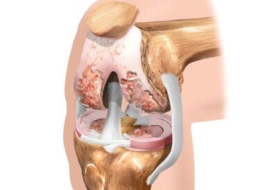 Damage to the articular joint of the knee