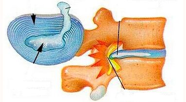 Characteristics of the Development of Cervical Osteochondition