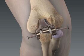 knee replacement for joints