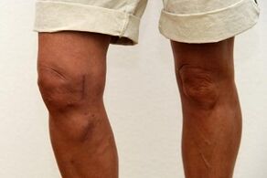 swelling of the knee joint due to arthritis