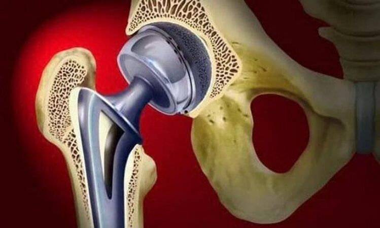 endoprosthetic